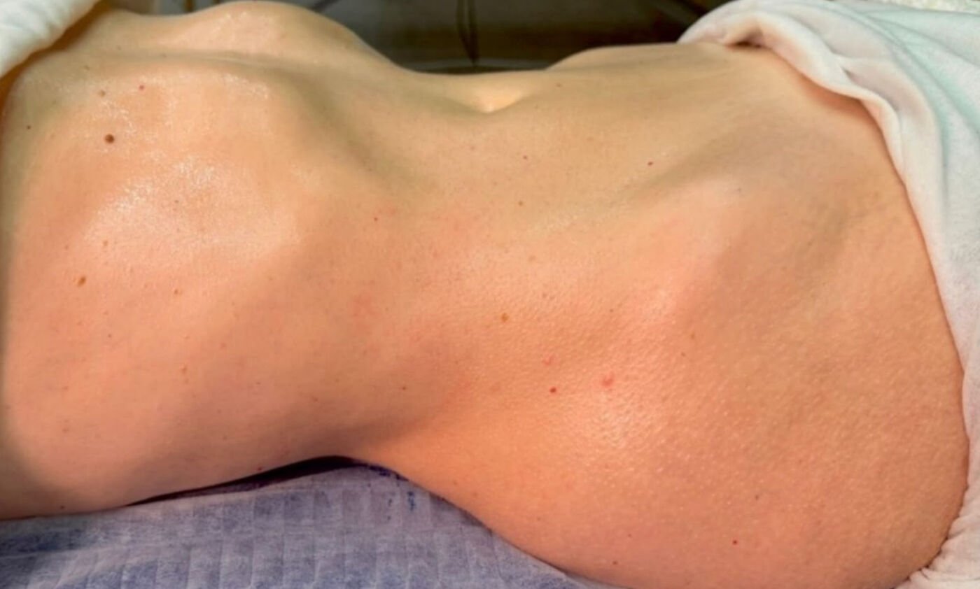 After Brazilian lymphatic drainage: flatter, more defined abdomen