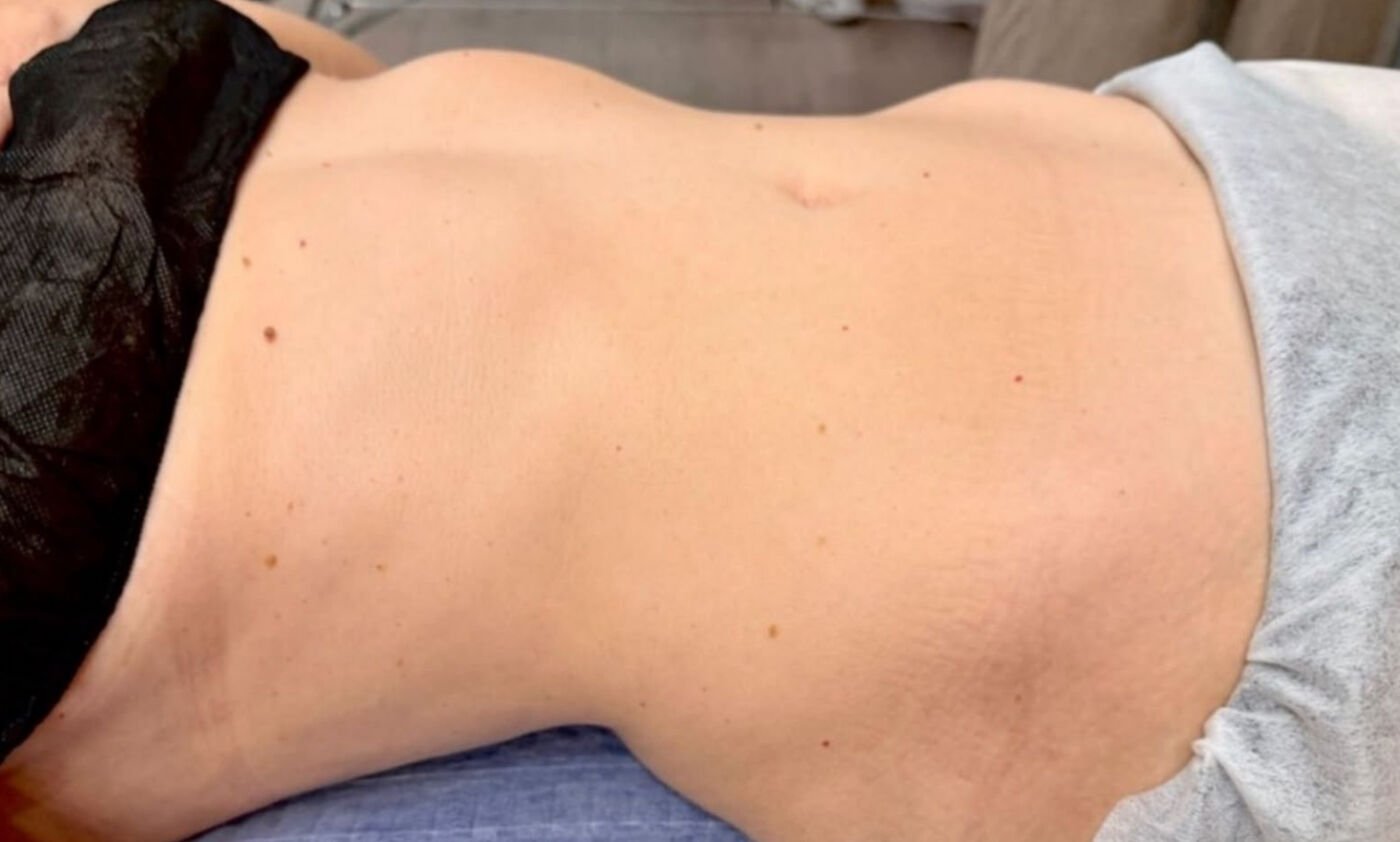 Before Brazilian lymphatic drainage
