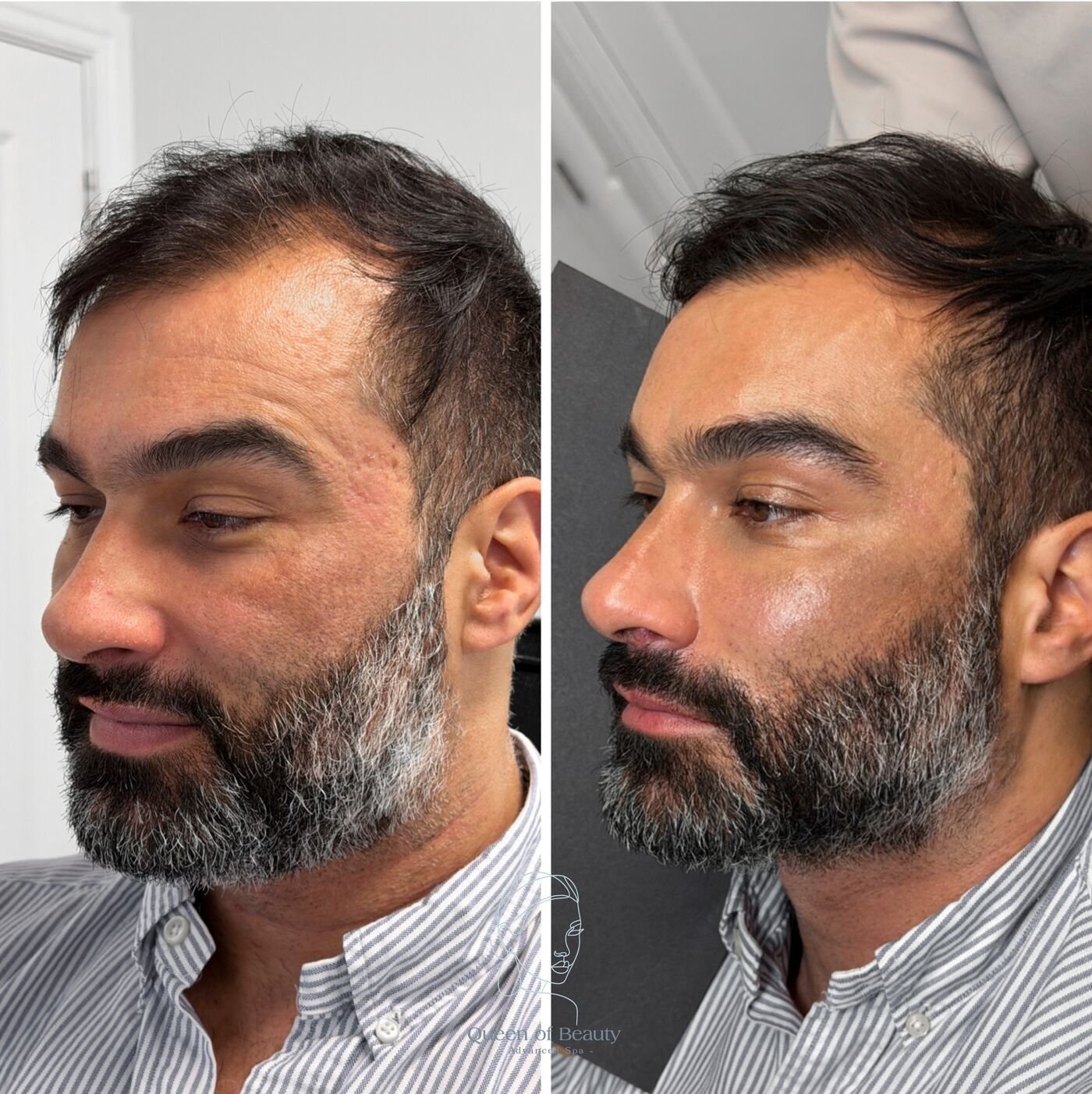 Before and after scalp microneedling for thinning hair