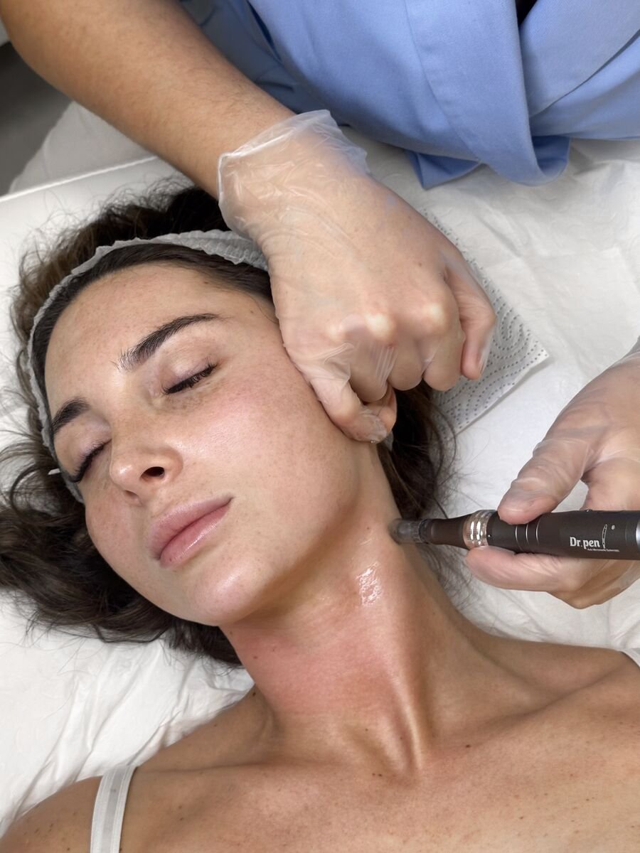 Microneedling treatment on the neck