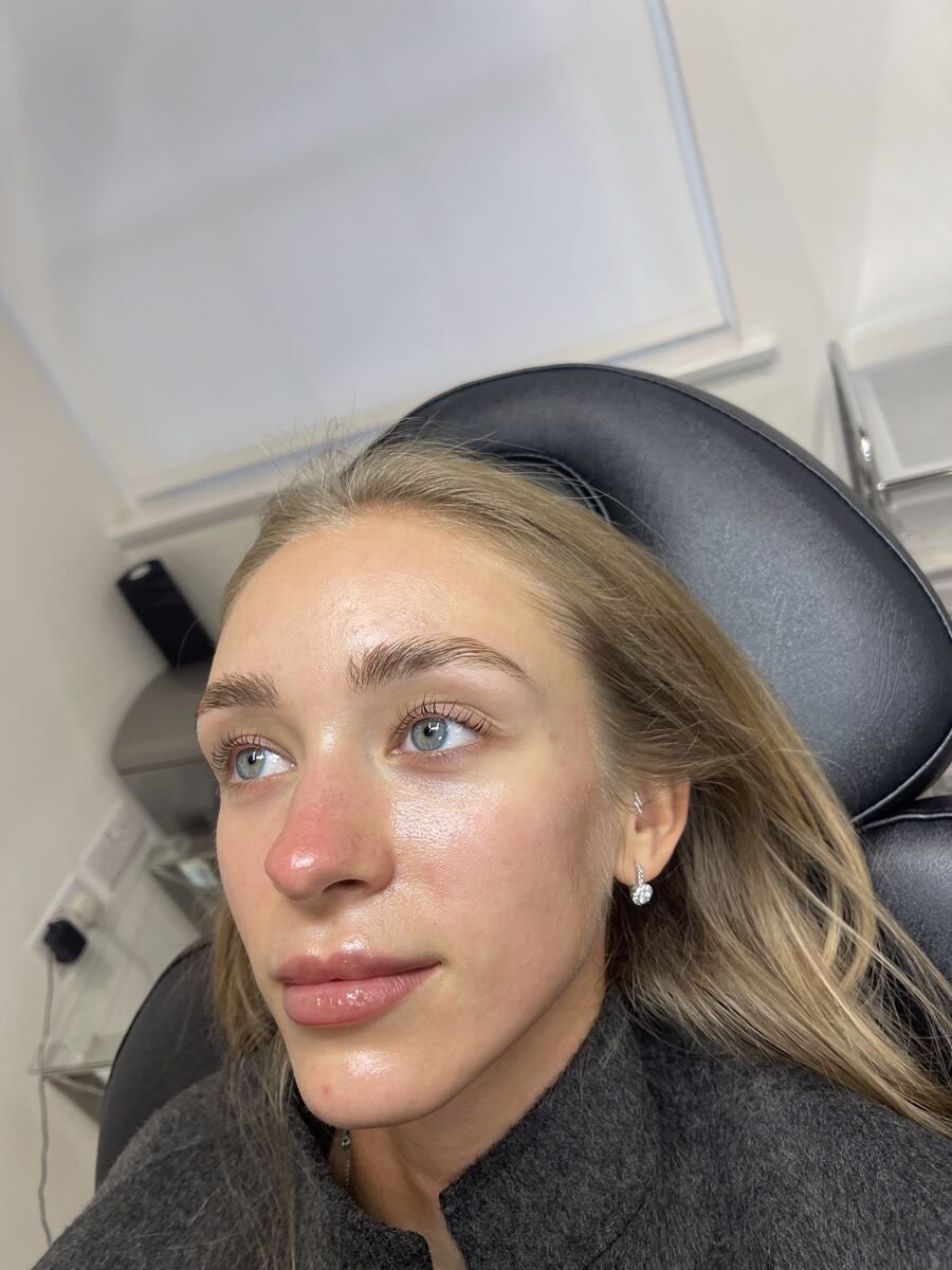 Client skin after treatment